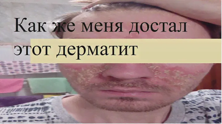 Болею себорейным дерматитом 8 лет. 2023